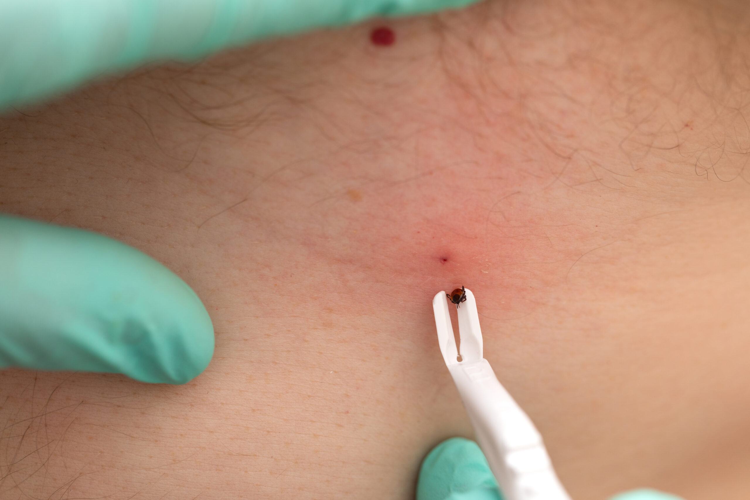Human hand using a tick removal tool to remove a tick from a human wearing gloves.