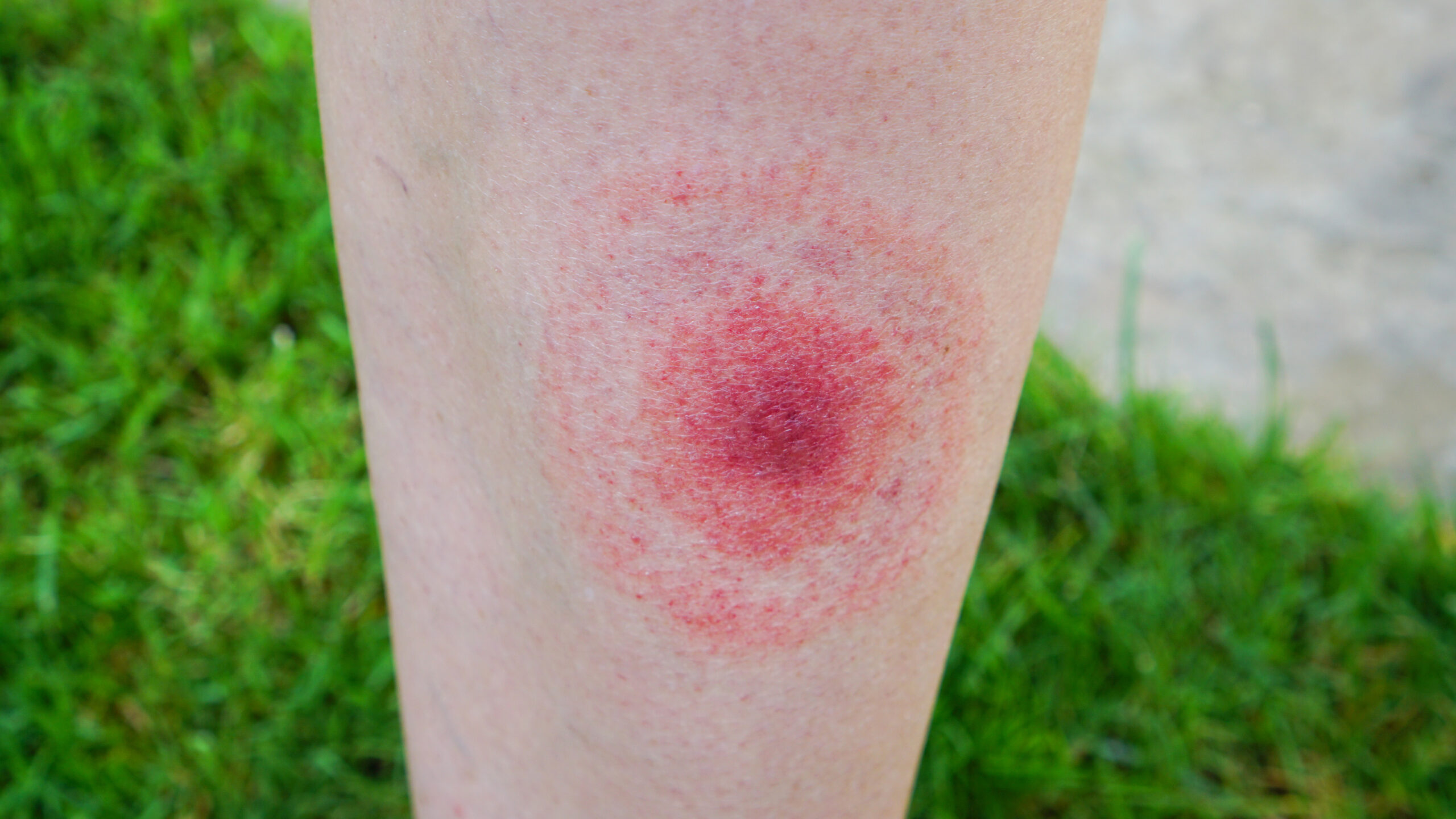 Leg of a person with a large round red rash.