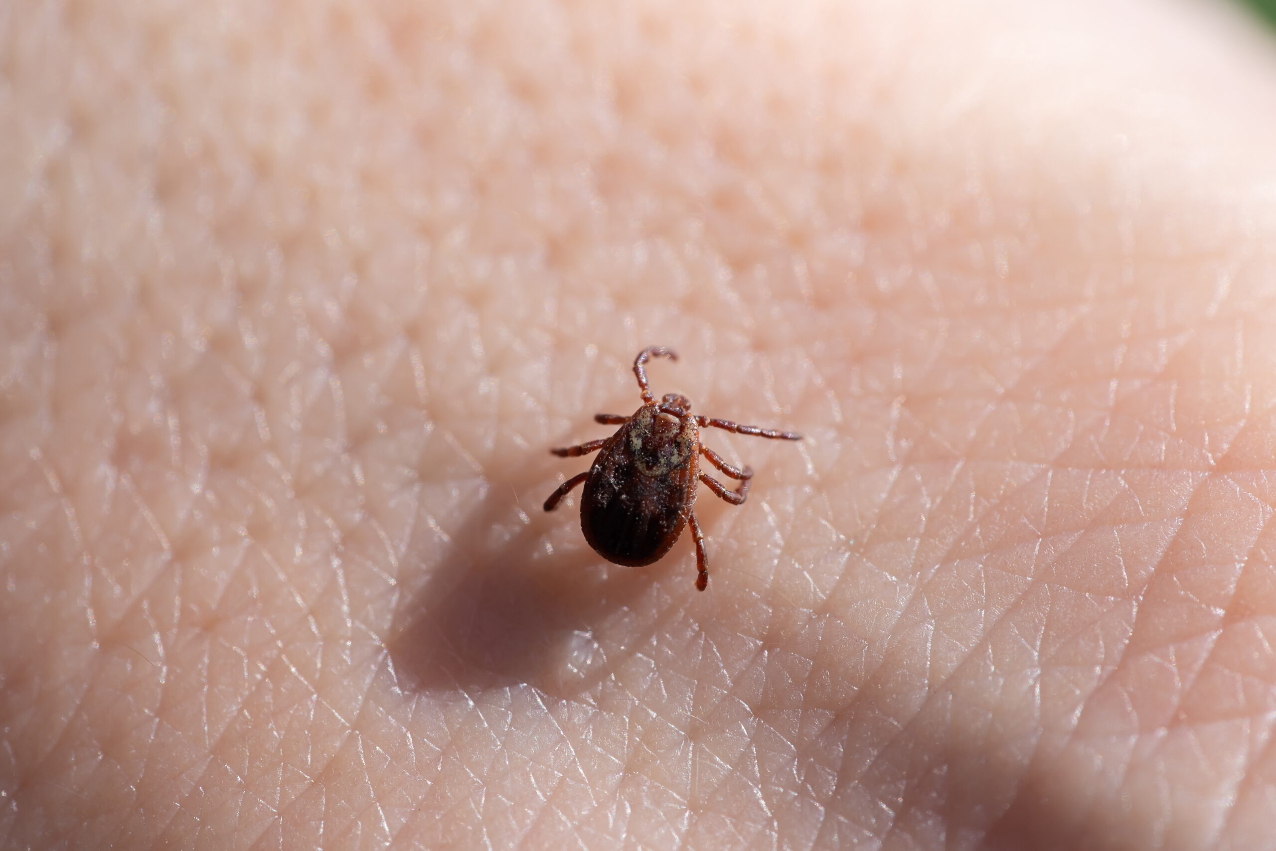 Tick on a fair skinned person.